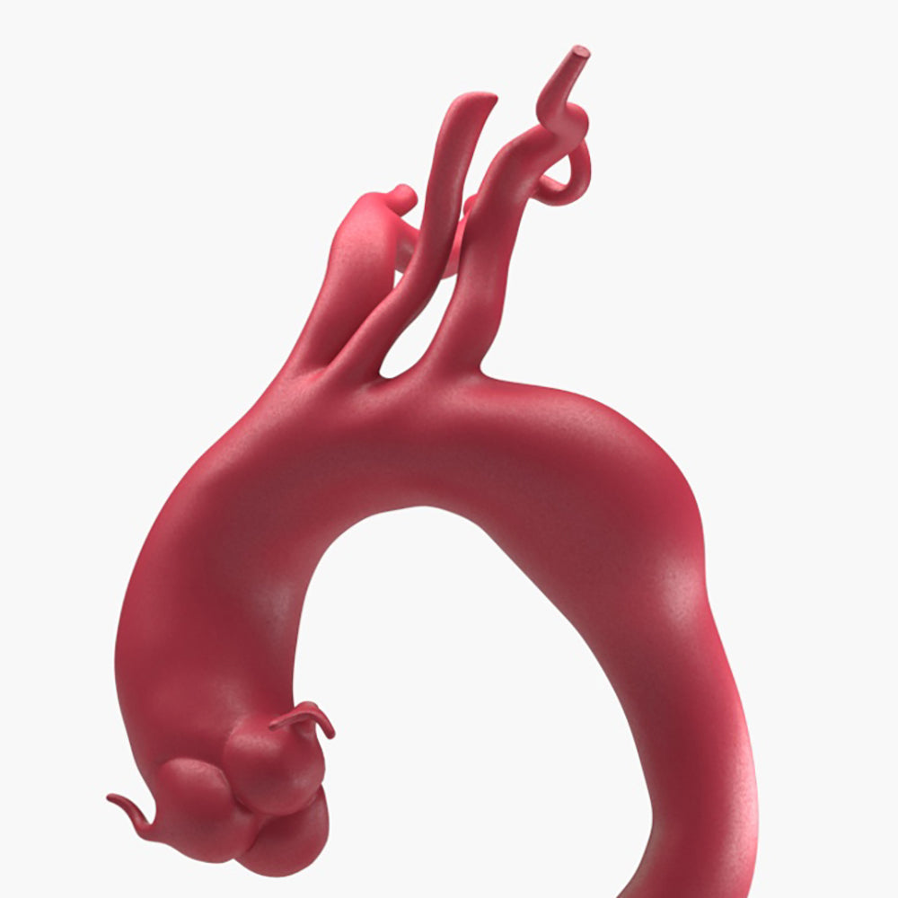 Fusiform Ascending & Descending Aortic Aneurysm 2