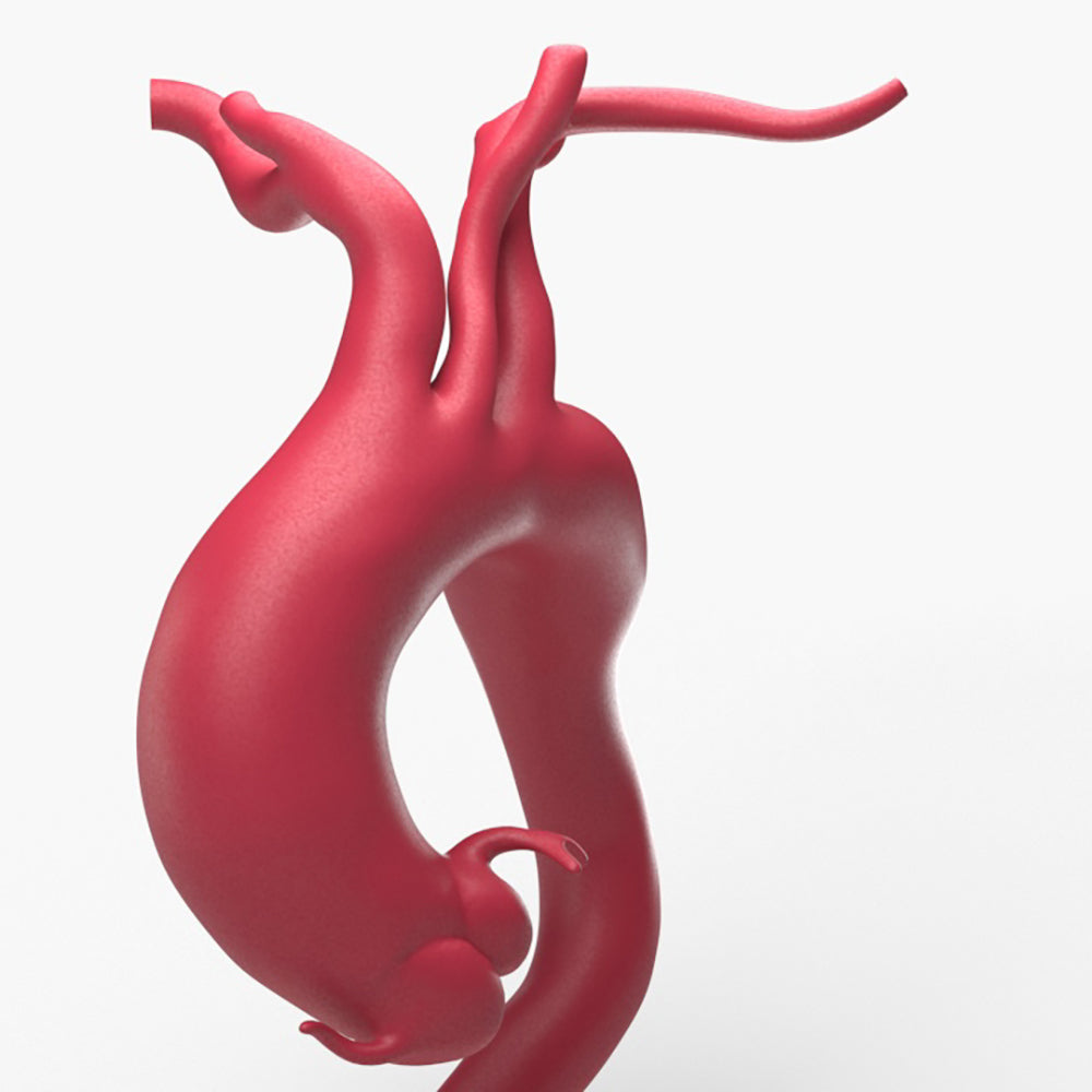 Fusiform Ascending & Descending Aortic Aneurysm 2