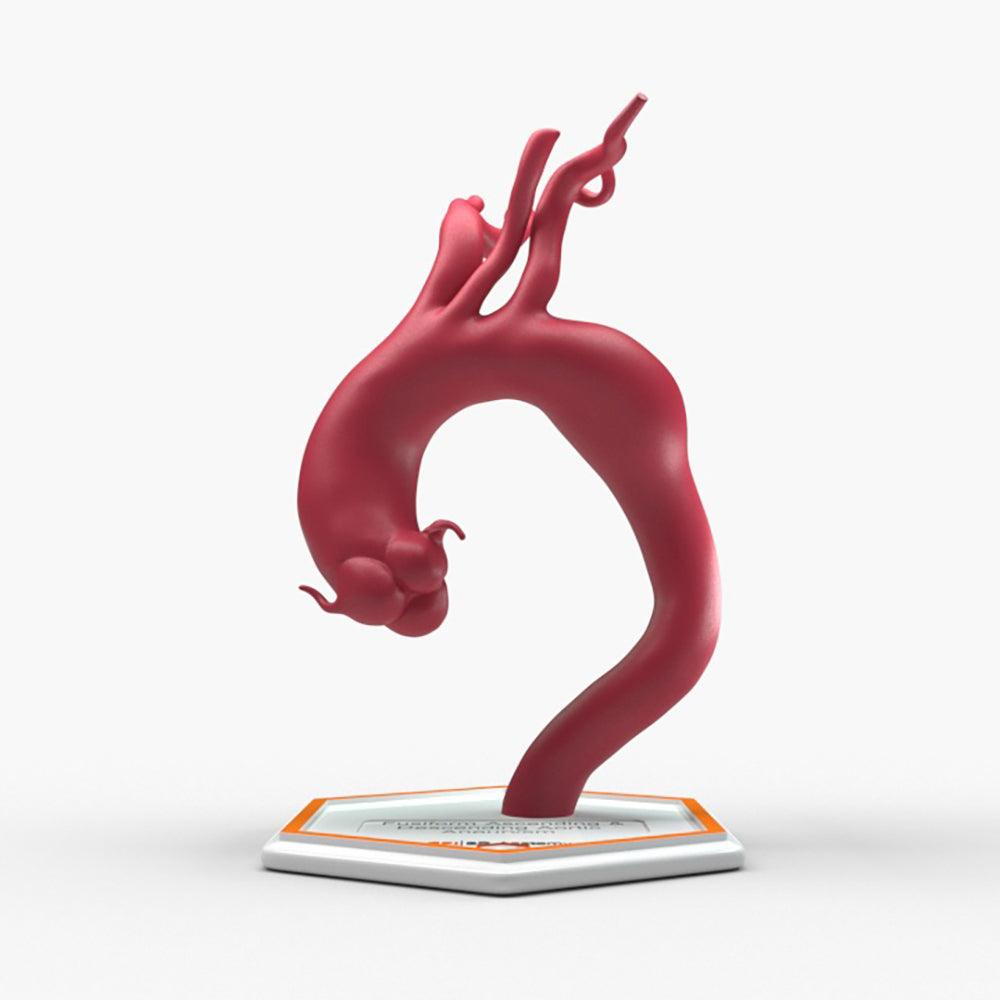 Fusiform Ascending & Descending Aortic Aneurysm 2