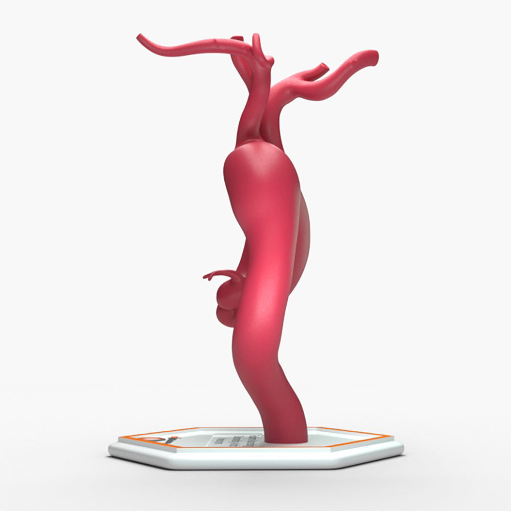 Fusiform Ascending & Descending Aortic Aneurysm 2