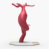 Fusiform Ascending & Descending Aortic Aneurysm 2