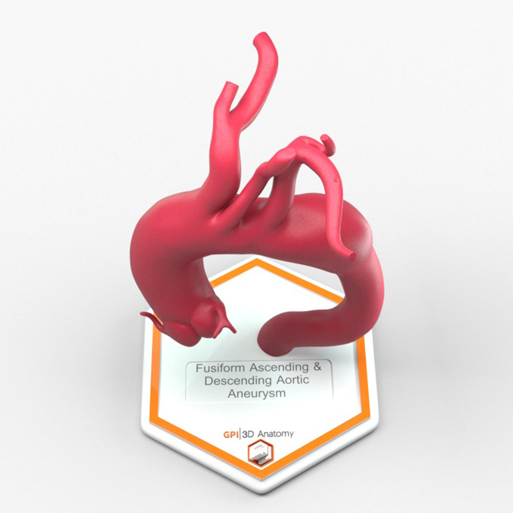 Fusiform Ascending & Descending Aortic Aneurysm 2