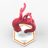 Fusiform Ascending & Descending Aortic Aneurysm 2