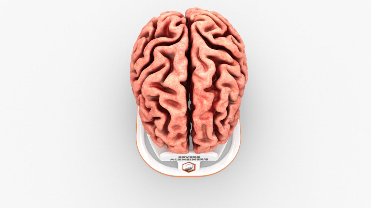 Adult Brain With Alzheimer’s Disease, Severe