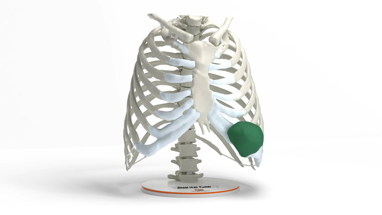 Chest Wall with Tumor