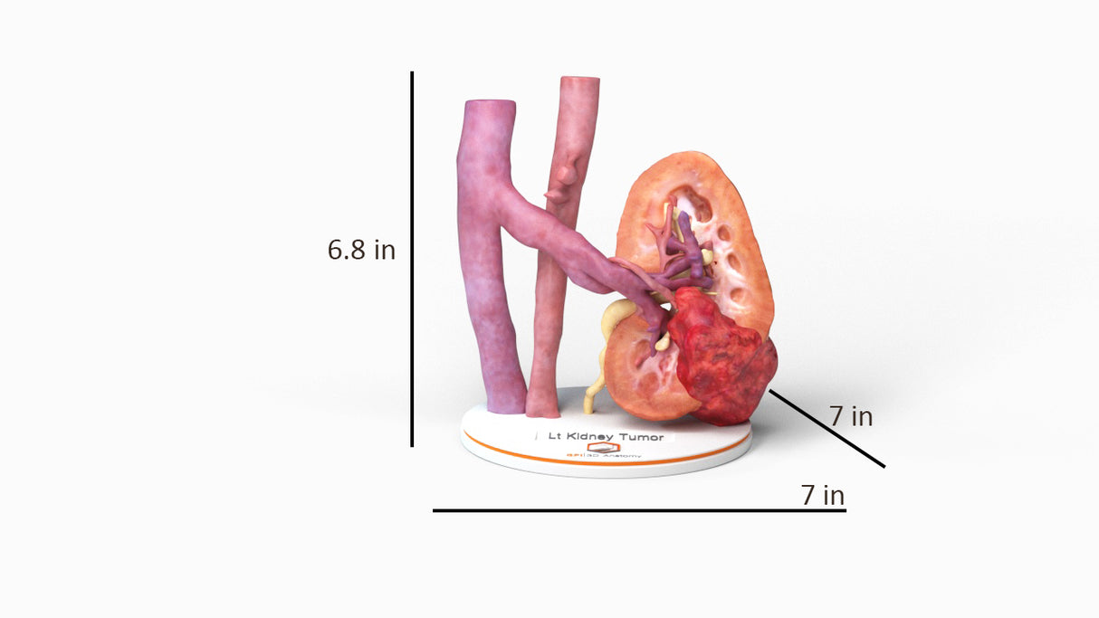 Realistic Left Kidney With Neoplasm - Male, 50 Years