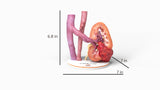Realistic Left Kidney With Neoplasm - Male, 50 Years
