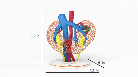 Lattice Horseshoe Kidney With Renal Cell Carcinoma (RCC) – Male, 41 Years