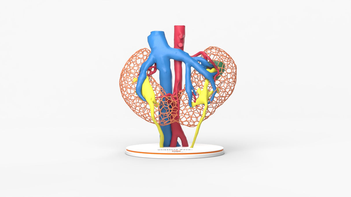 Lattice Horseshoe Kidney With Renal Cell Carcinoma (RCC) – Male, 41 Years