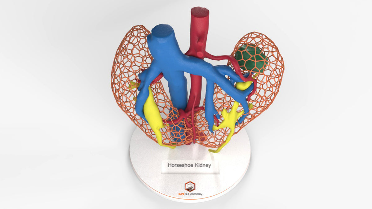 Kidney Cell Model Custom 3D Anatomy Models | Renal Cell Carcinoma | Horseshoe Kidney ...