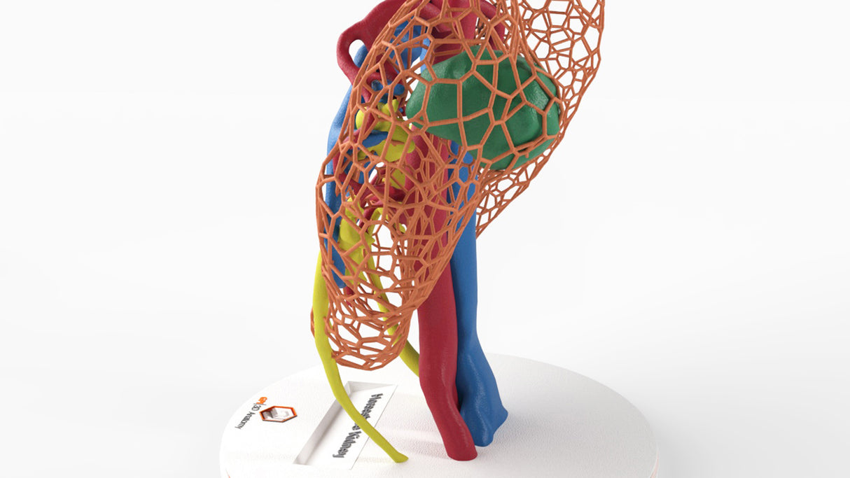 Lattice Horseshoe Kidney With Renal Cell Carcinoma (RCC) – Male, 41 Years