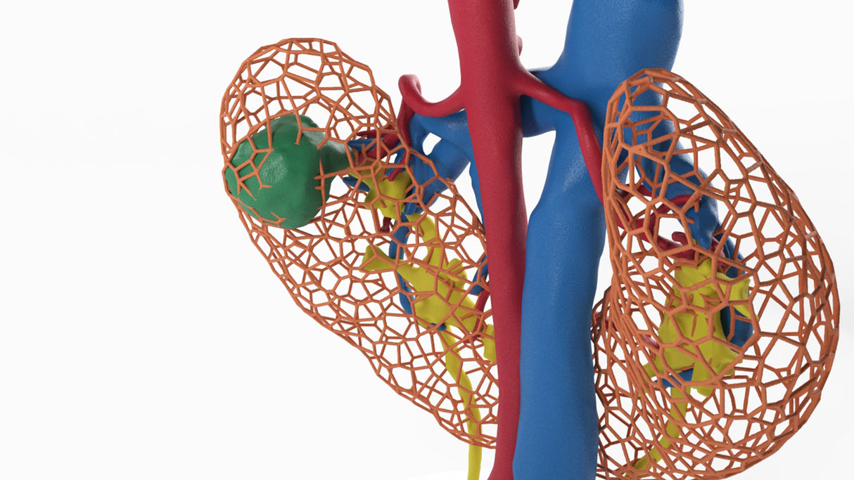 Lattice Horseshoe Kidney With Renal Cell Carcinoma (RCC) – Male, 41 Years