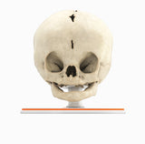 Infant Skull With Bilateral Craniosynostosis of the Coronal Suture - Female, 5 Months