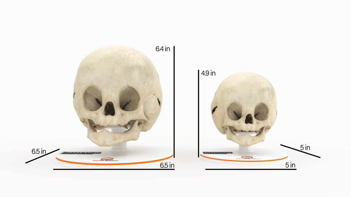 Infant Skull With Bilateral Craniosynostosis of the Lambdoid Suture - Male, 8 Months