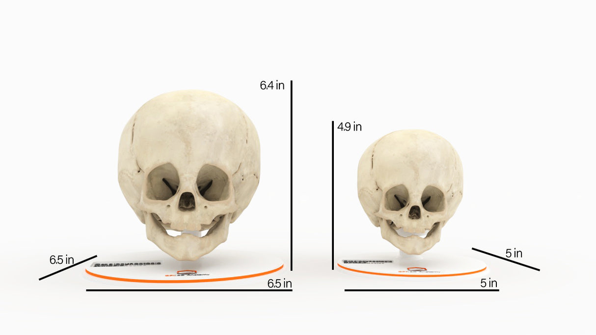 Infant Skull With Craniosynostosis of the Metopic Suture - Male, 8 Months