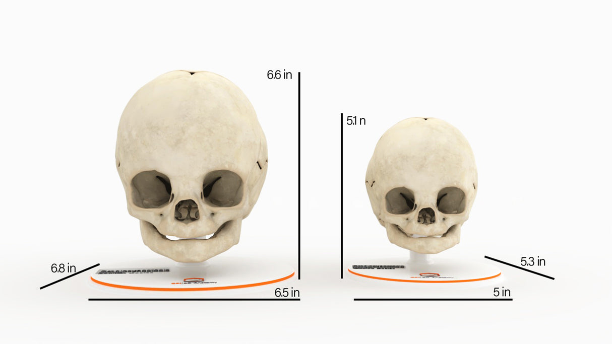 Infant Skull With Craniosynostosis of the Sagittal Suture - Male, 8 Months