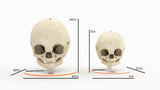 Infant Skull With Craniosynostosis of the Sagittal Suture - Male, 8 Months