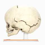 Infant Skull With Craniosynostosis of the Sagittal Suture - Male, 8 Months