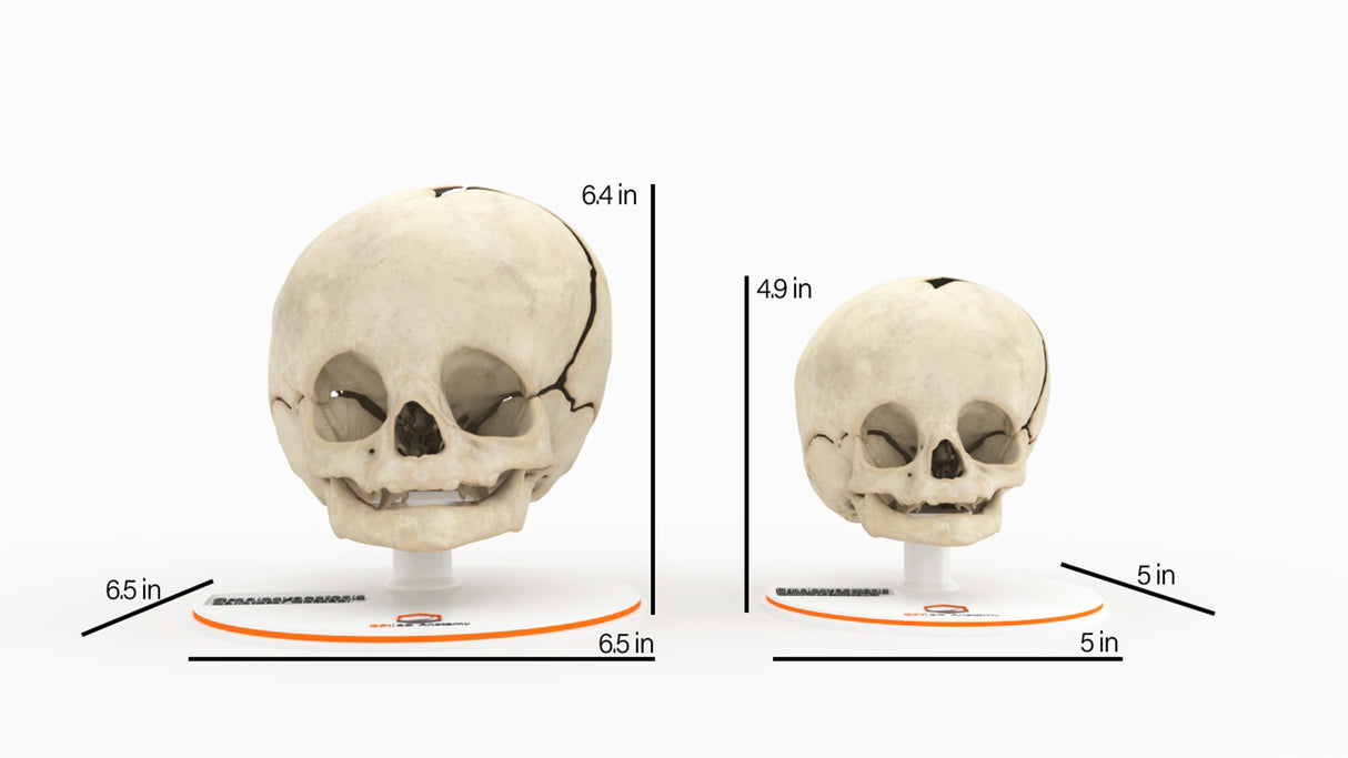 Infant Skull With Unilateral Craniosynostosis of the Coronal Suture - Male, 4 Months