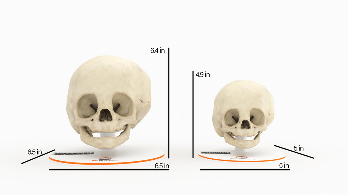 Infant Skull With Unilateral Craniosynostosis of the Lambdoid Suture - Female, 7 Months