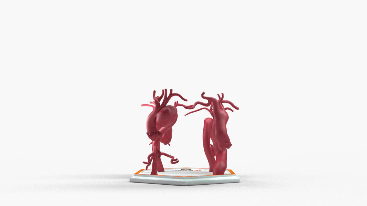 Aortic Arch Aneurysm Series – GPI 3D Anatomy