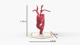 Aortic Arch - Fusiform Ascending Aneurysm