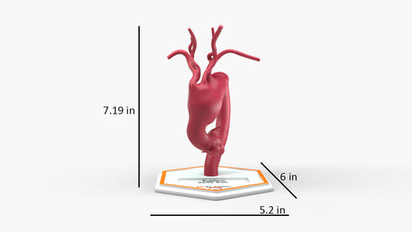 Aortic Arch - Fusiform Ascending Aneurysm