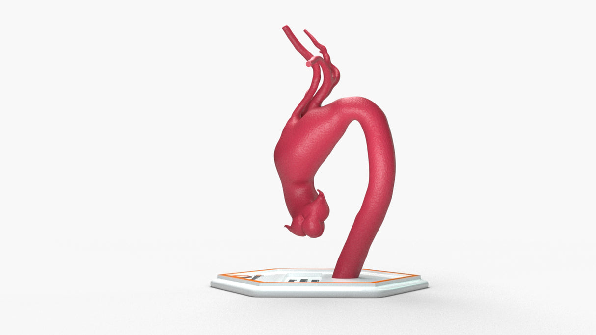 Aortic Arch - Fusiform Ascending Aneurysm