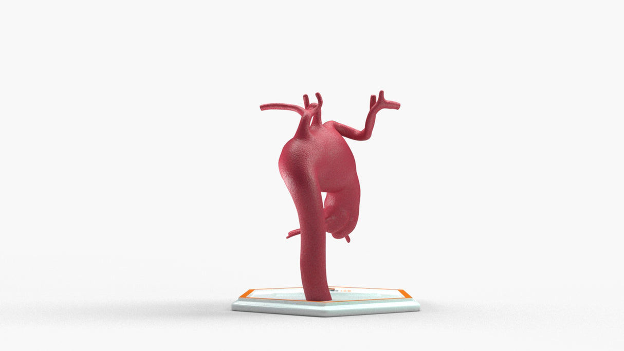 Aortic Arch - Fusiform Ascending Aneurysm