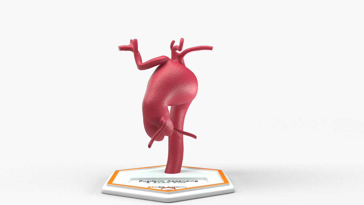 Aortic Arch - Fusiform Ascending Aneurysm
