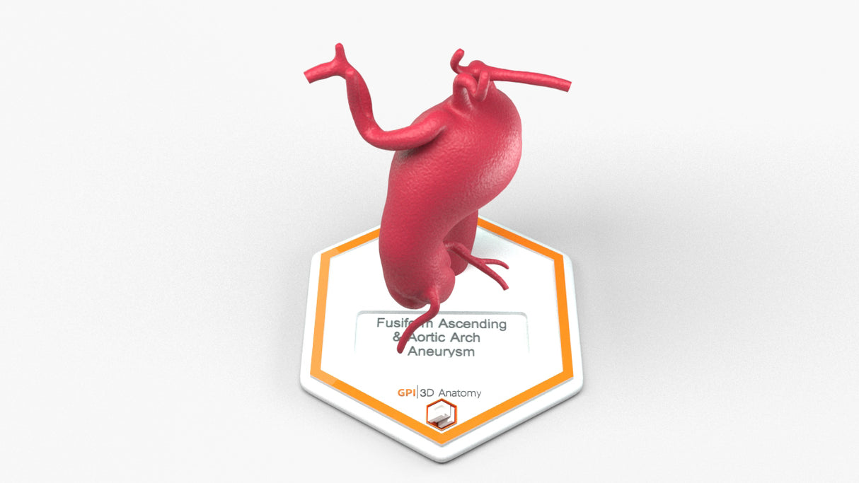 Aortic Arch - Fusiform Ascending Aneurysm