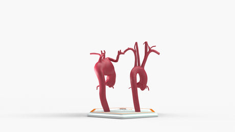 Aortic Arch - Normal and Fusiform Aneurysm