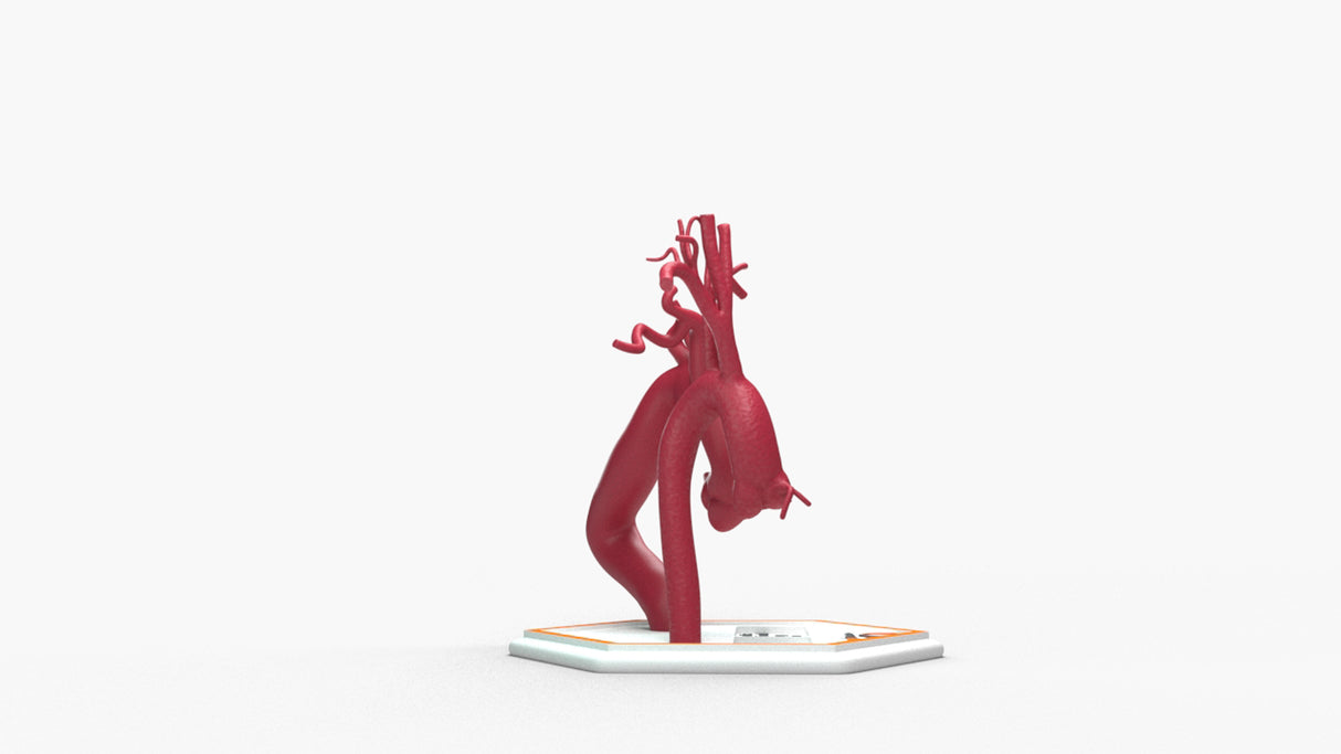 Aortic Arch - Normal and Fusiform with Proximal Descending Aneurysm