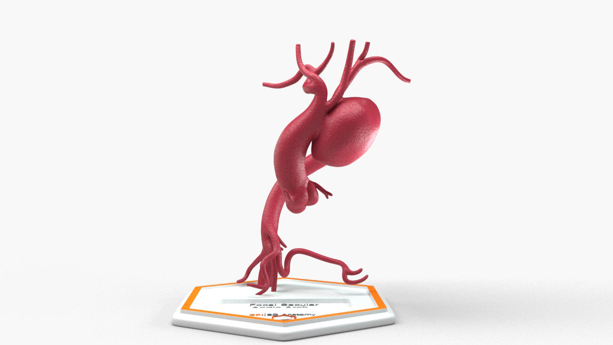 Aortic Arch - Focal Sacular Aneurysm