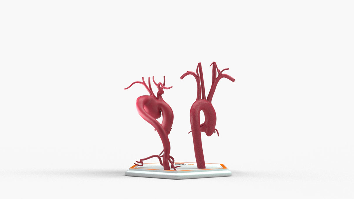 Aortic Arch - Normal and Focal Sacular Aneurysm