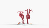 Aortic Arch - Normal and Focal Sacular Aneurysm