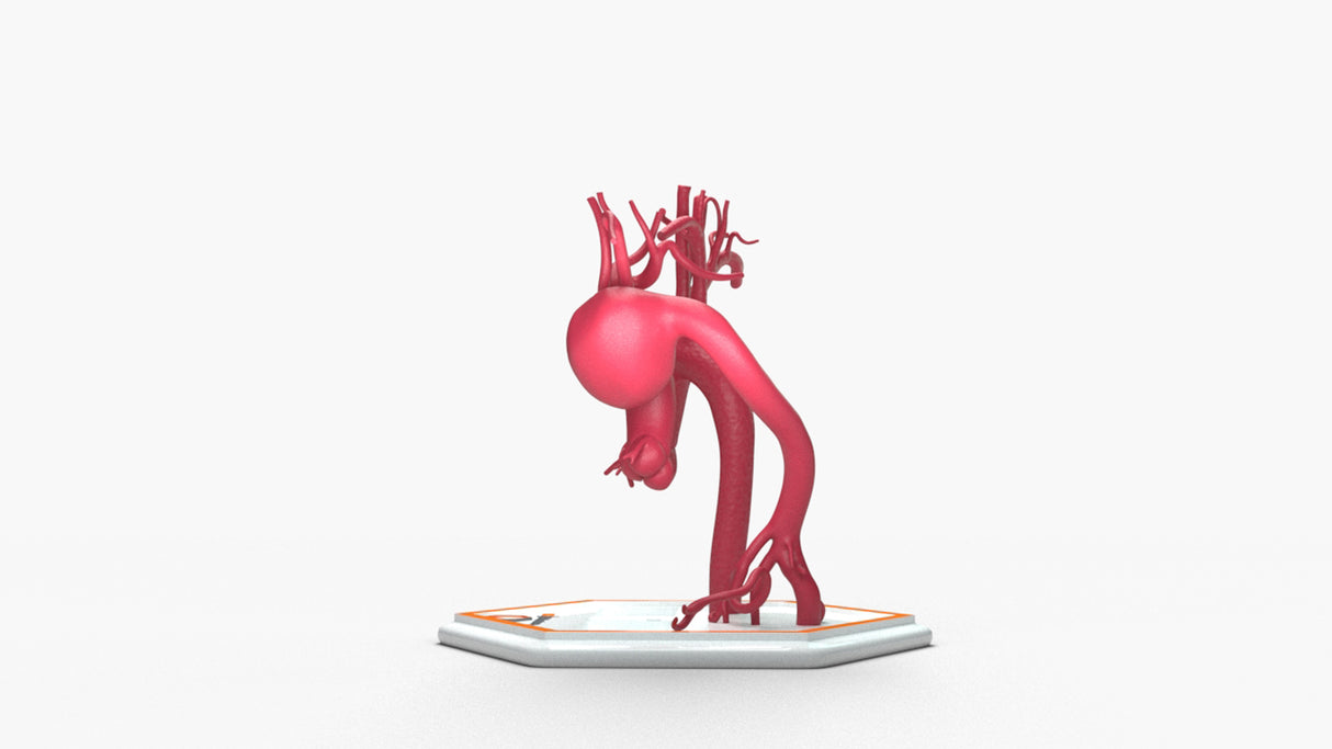 Aortic Arch - Normal and Focal Sacular Aneurysm