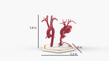 Aortic Arch - Normal and Focal Sacular Aneurysm