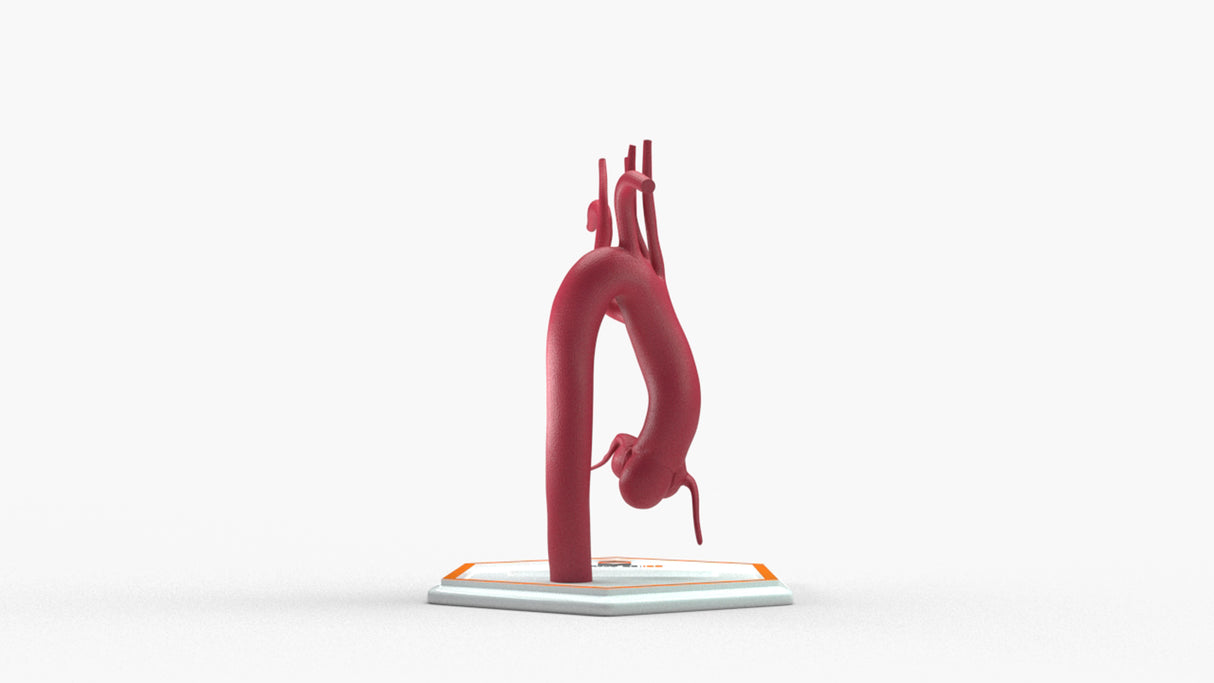 Kommerell's Diverticulum