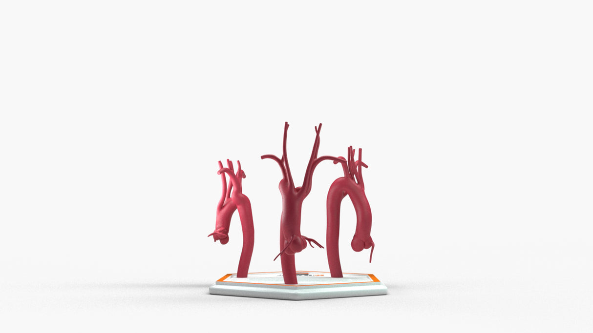 Kommerell's Diverticulum Series