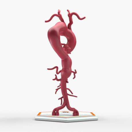 Thoracoabdominal Aortic Aneurysm Crawford Type 1
