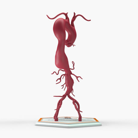 Thoracoabdominal Aortic Aneurysm Crawford Type 2
