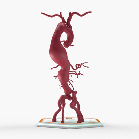 Thoracoabdominal Aortic Aneurysm Crawford Type 3