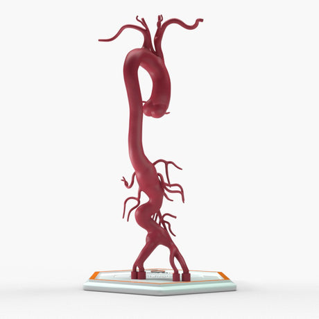 Thoracoabdominal Aortic Aneurysm Crawford Type 4