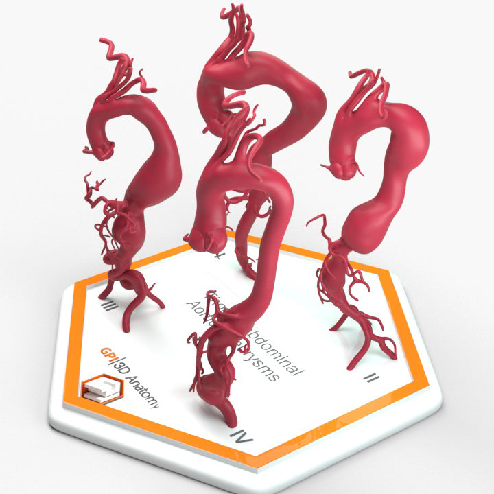 Thoracoabdominal Aortic Aneurysms 1-4
