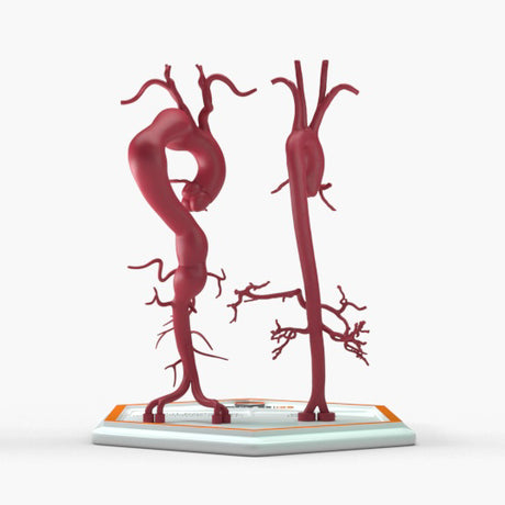 Thoracoabdominal Aortic Aneurysm Crawford Type 1 and Normal