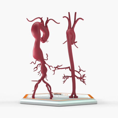 Thoracoabdominal Aortic Aneurysm Crawford Type 2 and Normal