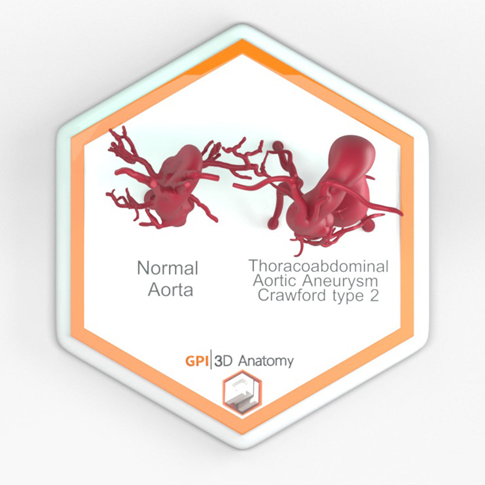 Thoracoabdominal Aortic Aneurysm Crawford Type 2 and Normal – GPI 3D ...