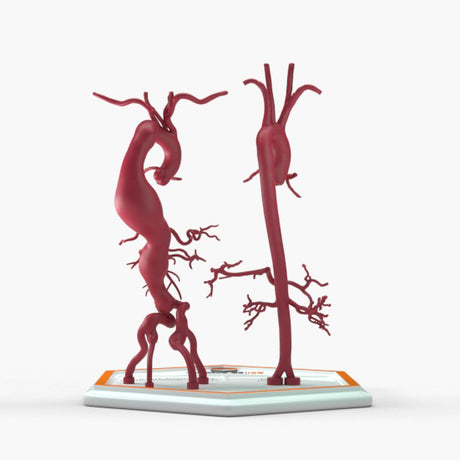Thoracoabdominal Aortic Aneurysm Crawford Type 3 and Normal