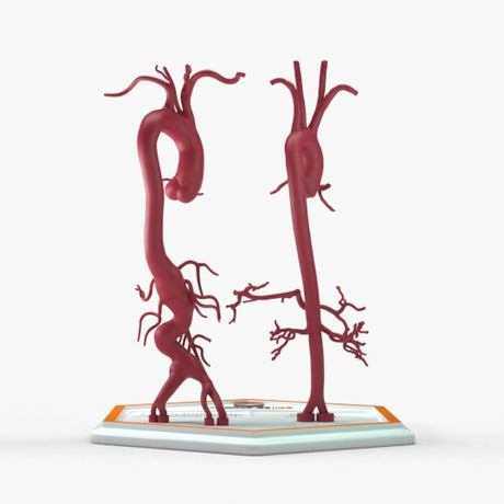 Thoracoabdominal Aortic Aneurysm Crawford Type 4 and Normal